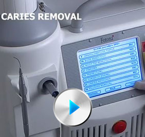 Caries Removal with Dental Laser